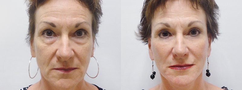 Rejuvenecimiento Facial fotos antes y después 7