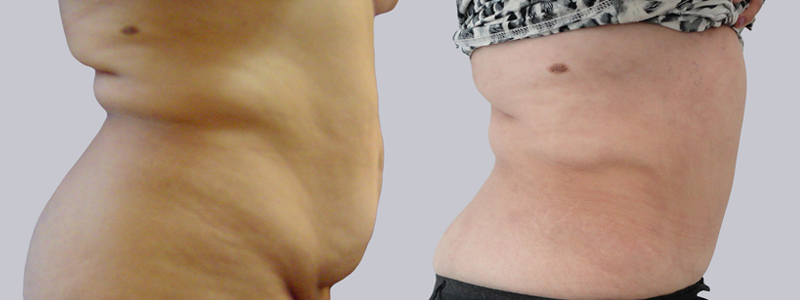 Abdominoplastia fotos antes y después 1