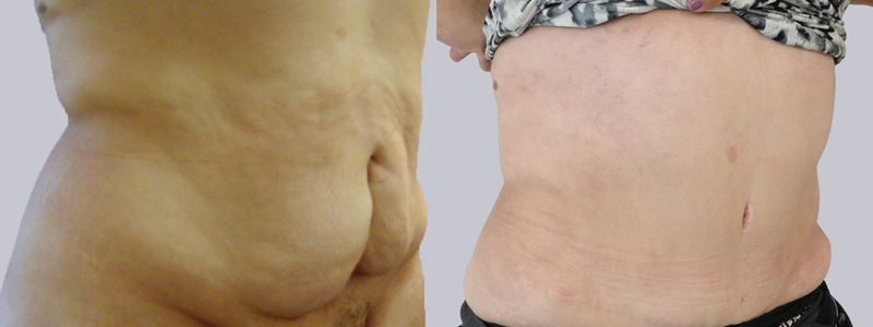 Abdominoplastia fotos antes y después 2