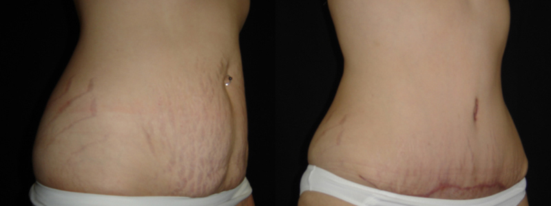Abdominoplastia fotos antes y después 5