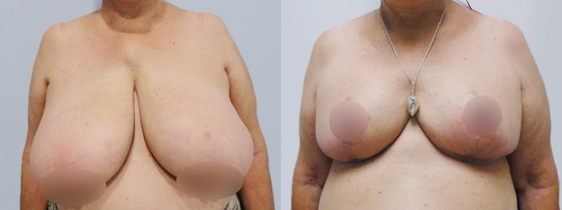 Mamoplastia fotos antes y después 1