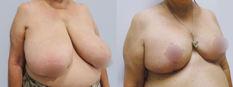 Mamoplastia fotos antes y después 3
