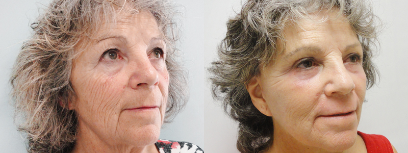 Rejuvenecimiento Facial fotos antes y después 6