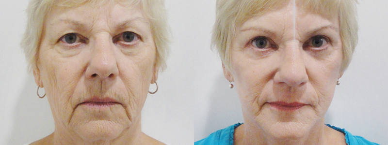 Rejuvenecimiento Facial fotos antes y después 3