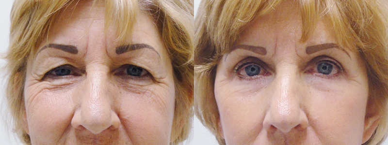blefaroplastia fotos antes y despues 5