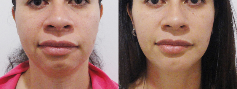 Mentoplastia fotos antes y después 3